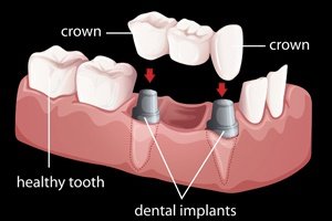 Implantes