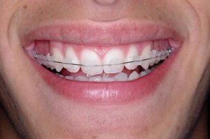 Brackets Cerámicos