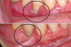 Periodoncia