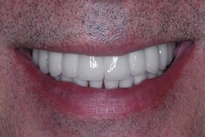 Implantes totales (prótesis fijas)